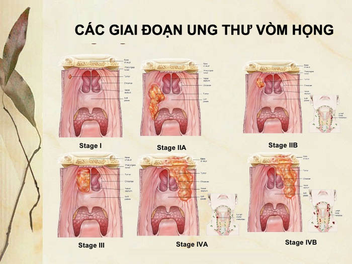 Các giai đoạn ung thư vòm họng